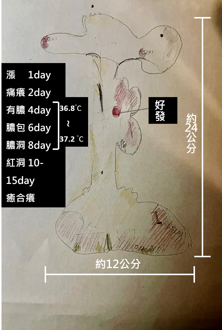 圖4.3.2 受訪者手繪的蟹足腫